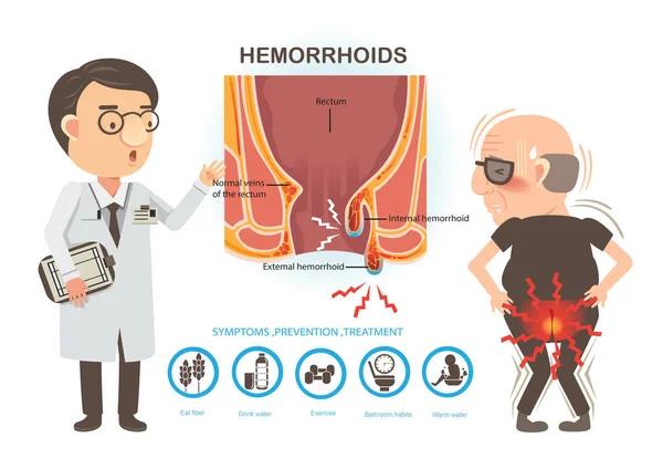 البواسير: أمراض وأعراض وتفكيك المفاهيم الخاطئة