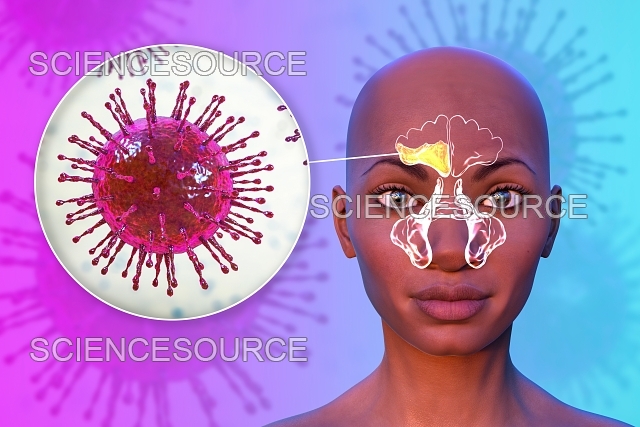 التهاب الجيوب الأنفية: أمراض وأعراض — نظرة علمية متجددة للمشكلة الصحية الشائعة