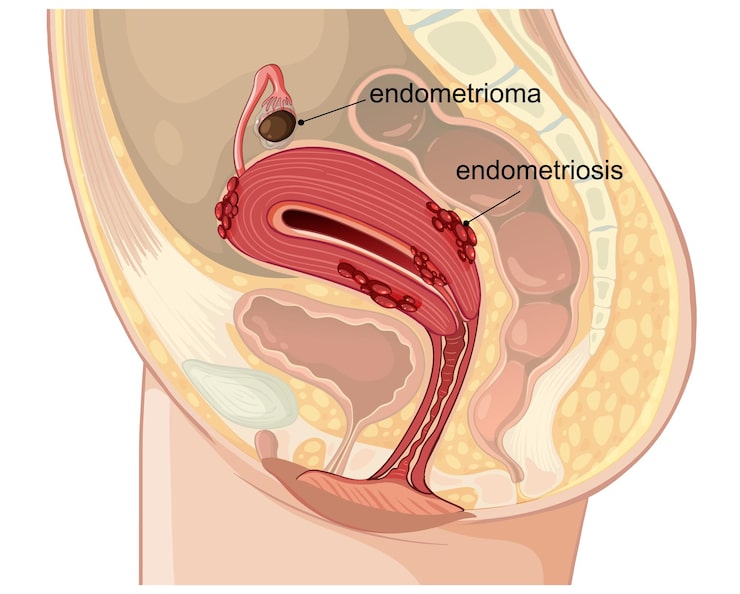 بطانة الرحم المهاجرة: دراسة علمية جديدة وتحليل شامل