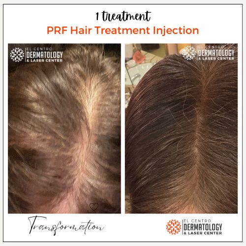 علاج تساقط الشعر: دليل شامل للعلاجات الطبيعية