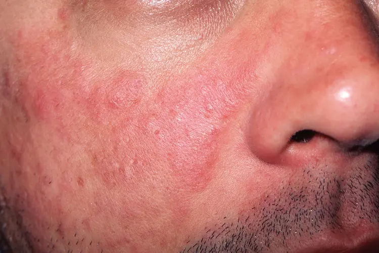 الذئبة الحمراء: تصنيفها وأعراضها الشاملة