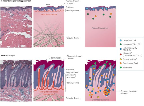 الصدفية: مرض جلدي مزمن يعكس تداخلات الجهاز المناعي والجمال الطبيعي