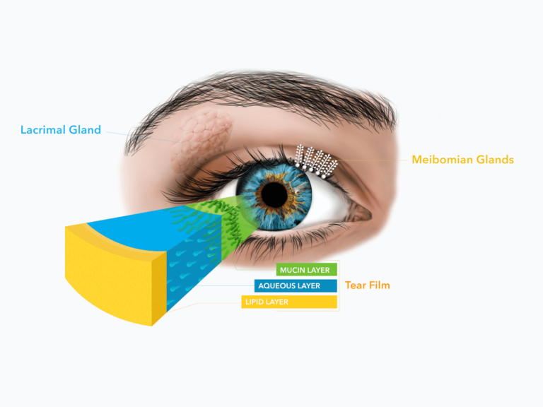 جفاف العين المزمن: تصنيف، أعراض، وأهمية العناية المتخصصة