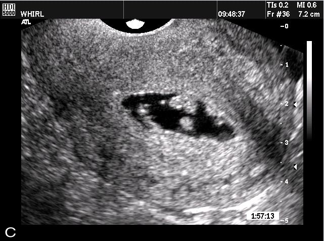 أعراض الحمل المبكرة: كشف الحقائق العلمية والتطورات الحديثة