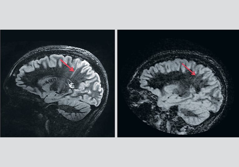 الصرع: تصنيف، أعراض، وطرق الوقاية الحديثة