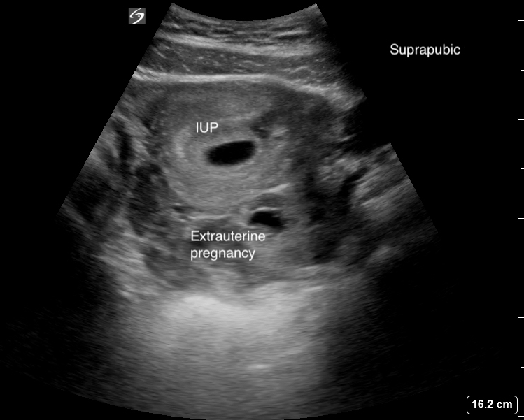 الحمل خارج الرحم: فهم عميق لمشكلة صحية خطيرة في صحة المرأة