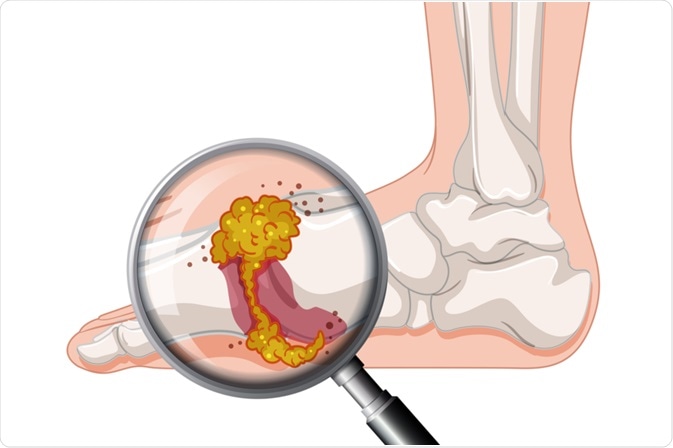النقرس: فهم مرض المعاناة والأعراض والتطورات الحديثة