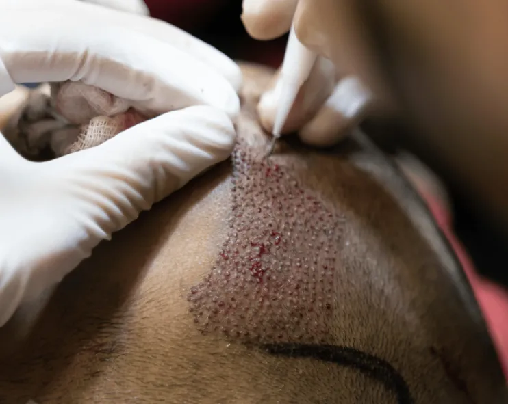 كيف تختار زراعة الشعر للرجال: تقنيات FUE وFUT والتعافي