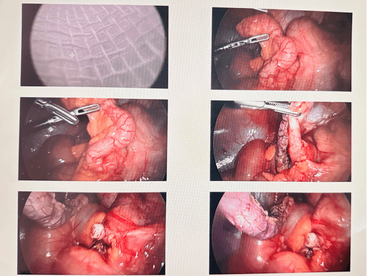 التهاب الزائدة الدودية: تصنيف جديد، تقنيات حديثة، وآفاق مستقبلية