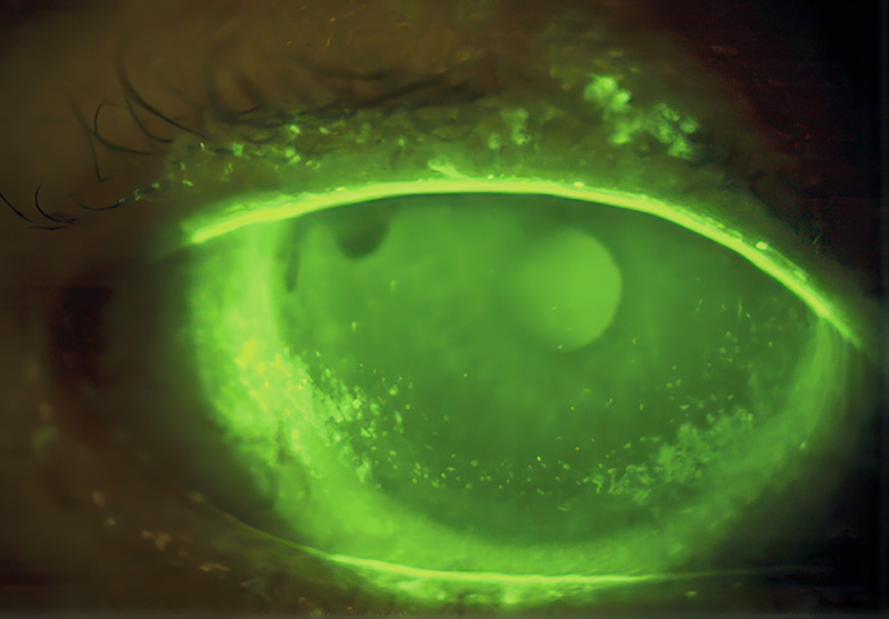 جفاف العين: الدليل الشامل للمبتدئين عن المرض والأعراض