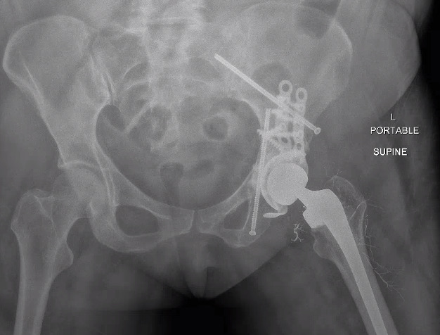 آلام الورك: بحث شامل عن التصنيف والأعراض والتطورات