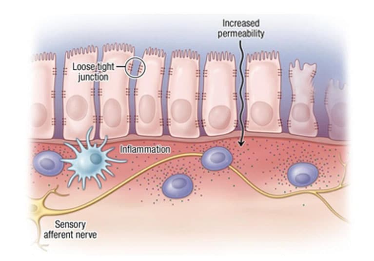 التهاب القولون التقرحي: دراسة شاملة لأمراض وأعراض الحالة