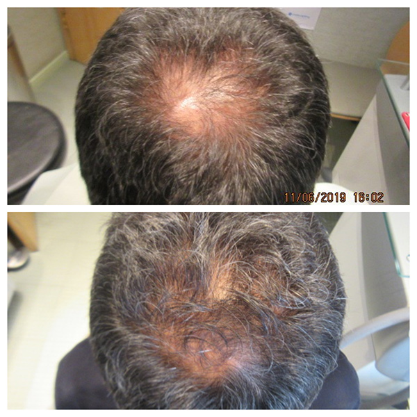 تساقط الشعر للرجال: فهم الظاهرة، التصدي للخرافات، وتبنّي المعرفة الصحيحة