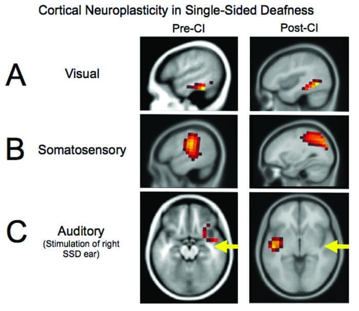 طنين الأذن المزمن: استكشاف شامل ضد الغموض والأحدث العلمي