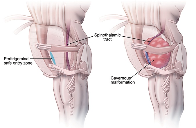 الصداع النصفي: فهم أعمق لظاهرة تؤرق حياة الملايين