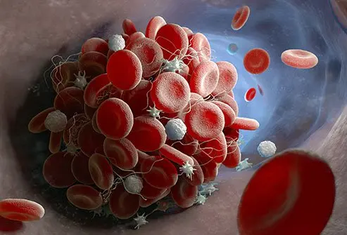 جلطة الساق: التصنيف والأعراض والطرق العلاجية والوقائية مع التوجهات الحديثة