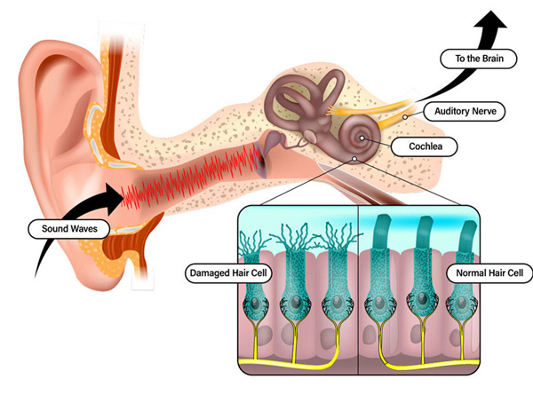 طنين الأذن: دليل شامل للمبتدئين حول الأعراض، الأسباب، والعلاج