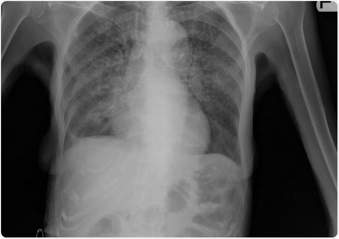السل الرئوي: مرض يُهدد الجهاز التنفسي ويحتاج إلى فهم شامل