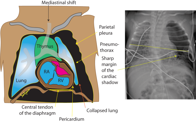 استرواح الصدر: نظرة شاملة على الحالة وأهم المعلومات الحديثة