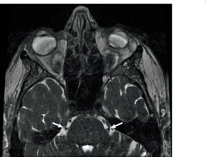 الصداع العنقودي: فهم دقيق وأفضل إدارة