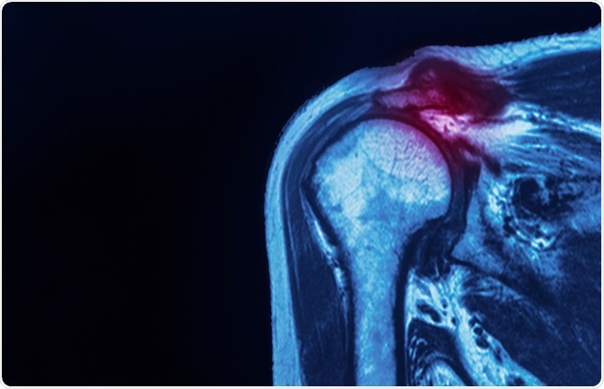 إصابات الكتف: تصنيفها، أعراضها، وأساليب التشخيص