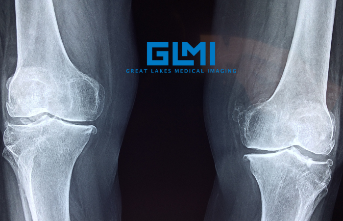 الكسور الإجهادية: مرض يتسلل بصمت ويهدد صحة العظام