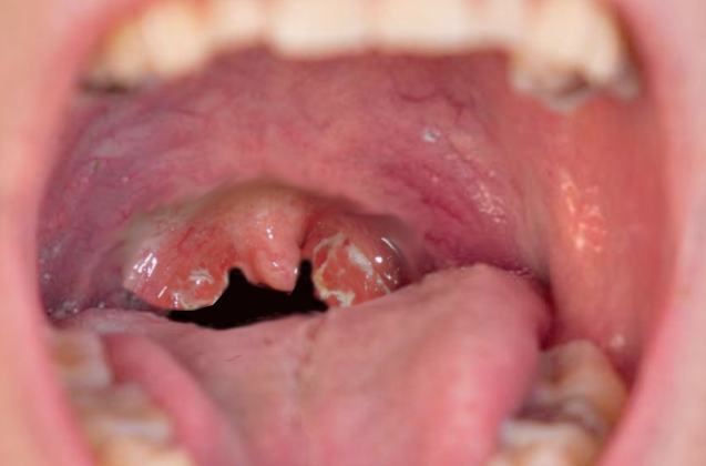 التهاب اللوزتين المزمن: الدليل الشامل للمبتدئين