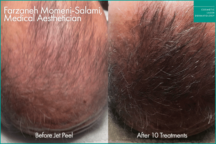 تساقط الشعر للرجال: أحدث الاتجاهات العلمية والتطورات المستقبلية