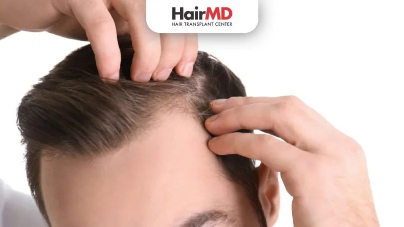 علاج تساقط الشعر بالتعريفات الطبيعية: دليل شامل ومتجدد