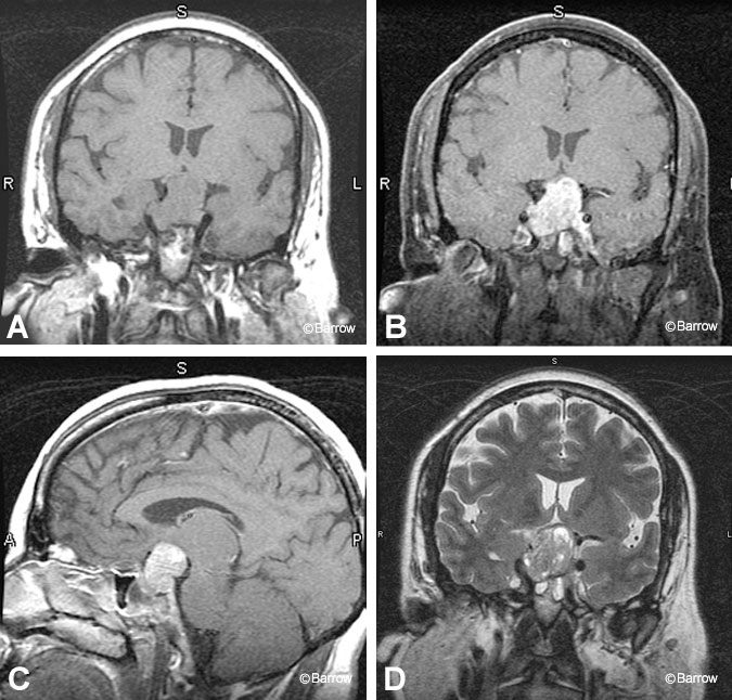 ورم الغدة النخامية: دليل شامل للمبتدئين حول التصنيف والأعراض
