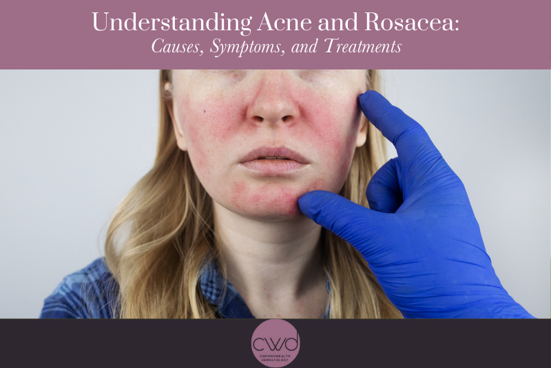 الوردية: استكشاف مرض مزمن يصعب التنبؤ به ويتطلب وعيًا عميقًا