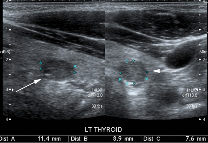 أورام الغدة الدرقية: تصنيفها، أسبابها، وأحدث ما توصل إليه العلم